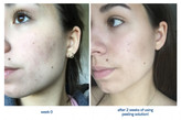 سرم پیلینگ و لایه بردار اوردینری Ordinary peeling AHA 30%+BHA 2٪ حجم ۳۰ میلی لیتر