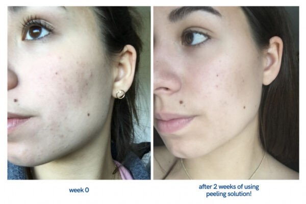سرم پیلینگ و لایه بردار اوردینری Ordinary peeling AHA 30%+BHA 2٪ حجم ۳۰ میلی لیتر