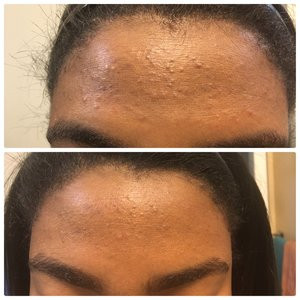 سرم پیلینگ و لایه بردار اوردینری Ordinary peeling AHA 30%+BHA 2٪ حجم ۳۰ میلی لیتر